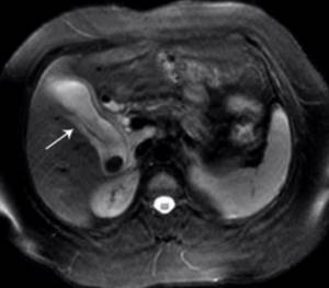 acute cholecystitis on MRI of the gallbladder