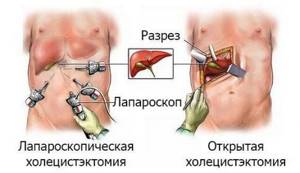The difference between laparoscopic cholecystectomy and open