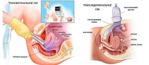 difference between traditional ultrasound and transvaginal ultrasound