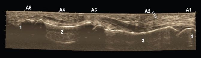 Panoramic sonogram of a longitudinal section of the deep and superficial digital flexor tendons