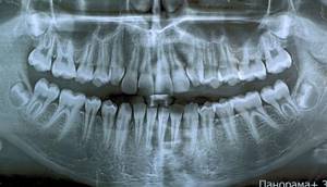 панорамный рентген зубов
