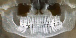 Panoramic image from CBCT
