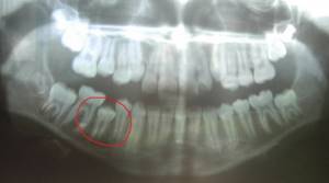 panoramic dental image