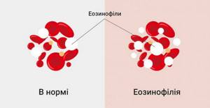 Pathogenesis of eosinophilia