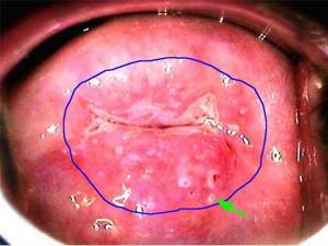 Pathological changes in the cervix