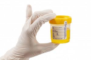 PCR 12 in urine