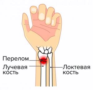 fracture of the radius of the wrist