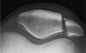 Fracture of the patella (kneecap) on CT