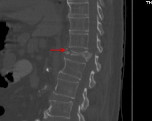Spinal fracture on CT