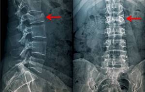 Spinal fracture on x-ray