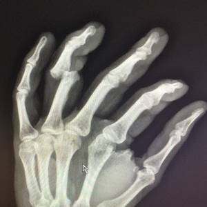 displaced fracture photo