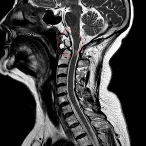 fracture of the second cervical vertebra on MRI