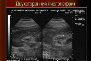 Pyelonephritis on ultrasound