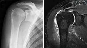 Shoulder joint on x-ray and MRI