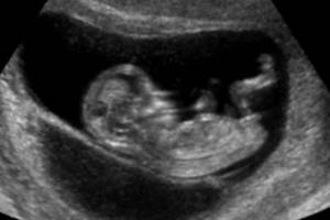 fetus 12 weeks on ultrasound 2nd trimester