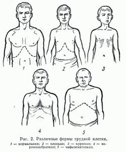 Flat chest deformity