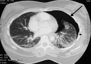 Pneumothorax on CT image