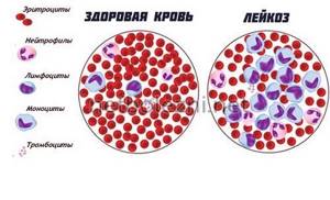 Why does leukemia develop?