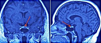 Preparing for MRI of the pituitary gland with contrast