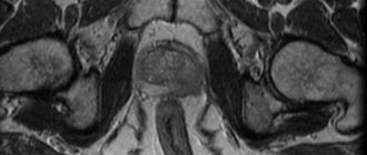 Preparation for MRI of the pelvis in men