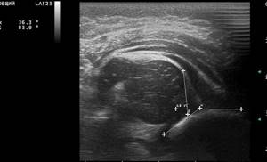 Subluxation of the hip joint on ultrasound