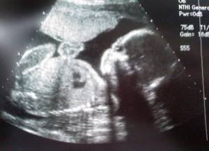 baby&#39;s gender on ultrasound