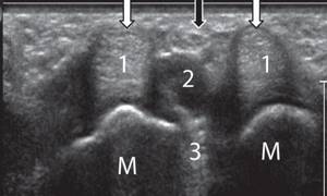 Transverse sonogram of the palmar surface of the hand