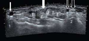 Transverse sonogram of the palmar surface of the wrist joint