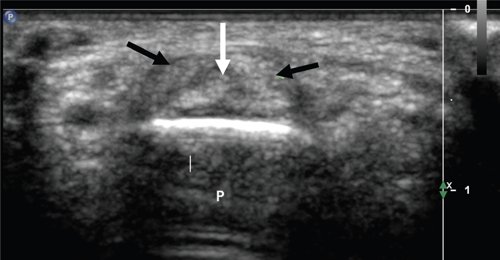 Transverse sonogram of the palmar surface of the finger at the level of the proximal interphalangeal joint