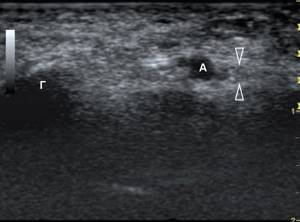 Transverse sonogram of the ulnar nerve at the level of Guyon&#39;s canal