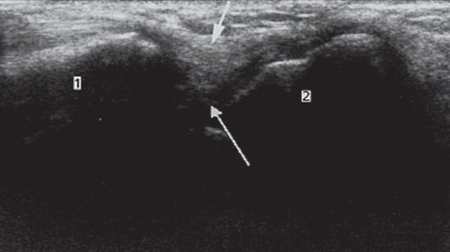 Transverse sonogram showing the scapholunate ligament, which connects the scaphoid and lunate bones