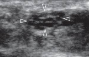Transverse sonogram of the median nerve at the level of the carpal tunnel
