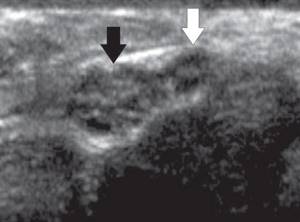 Transverse sonogram of the median nerve as it exits the carpal tunnel