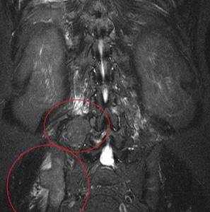 lesions of the pelvic bones on MRI