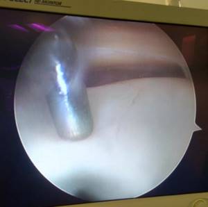 knee cartilage damage