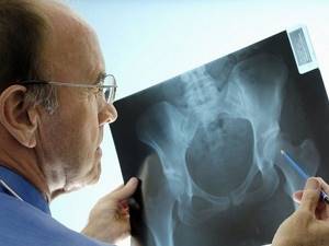 Causes and risk factors for bone cancer