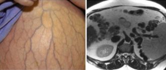 Признаки цирроза: желтушность кожных покровов