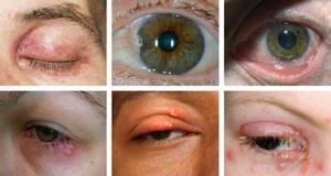 Signs of ophthalmoherpes
