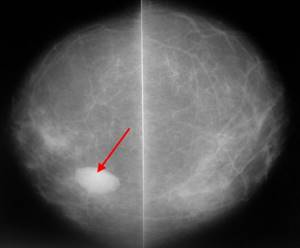 Signs of a tumor on a breast x-ray