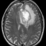 Signs of a malignant tumor on an MRI of the brain
