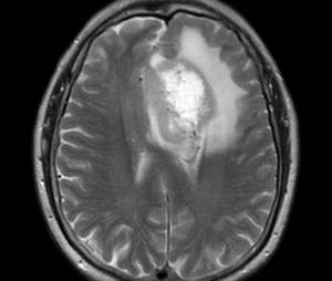 Signs of a malignant tumor on an MRI of the brain