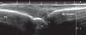 Longitudinal sonogram of the extensor of the third finger of the hand