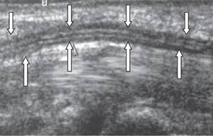 Longitudinal sonogram of the median nerve (light arrows) at the level of the carpal tunnel