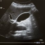 projection of the gallbladder on the screen during an ultrasound scan