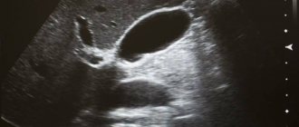 projection of the gallbladder on the screen during an ultrasound scan