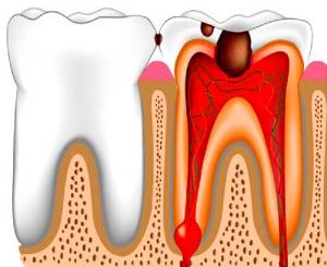 Tooth pulpitis classification what is it