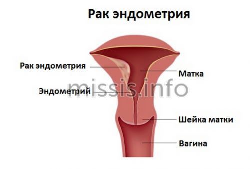 Endometrial cancer in a woman
