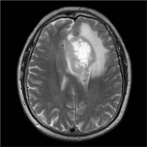 Brain cancer in MRI image