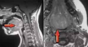Laryngeal cancer on MRI image