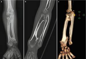 Bone cancer on CT images